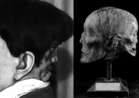 Conheça a trágica história de gêmeo siamês que tinha 'face do mal' que o levou a morte