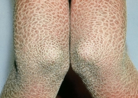 Menina fica com pele 'dura' como pedra devido a doença rara