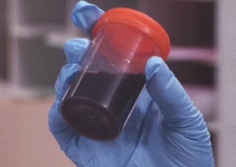 Após casos no Amazonas, 4 casos de 'doença da urina preta' são investigados no Pará