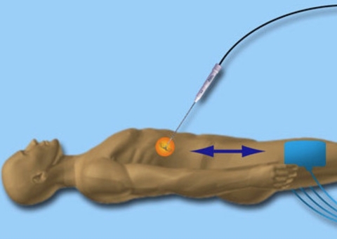 Ablação por radiofrequência é opção eficaz no tratamento de tumores