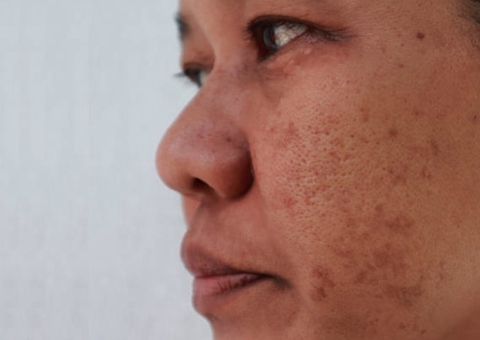 Manchas de melasma na pele tem cura? Saiba mais