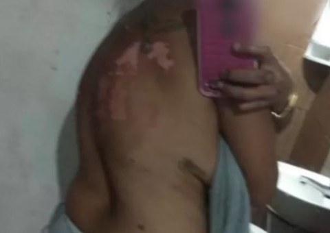 Homem tem crise de ciúmes e joga óleo quente na própria companheira