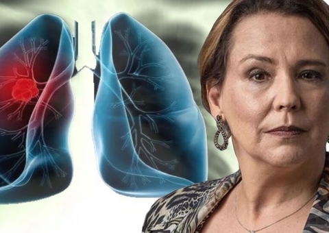Câncer de Pulmão: Saiba as causas, sintomas e tratamento da doença de Ana Beatriz Nogueira