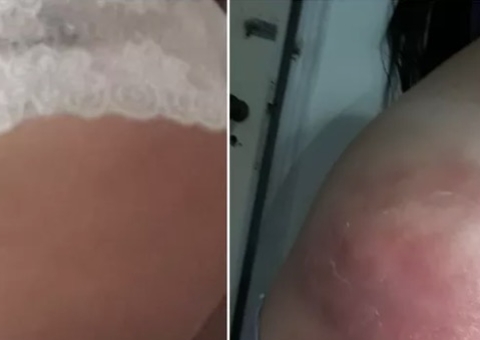 Mulher fica com bumbum deformado após injeção em unidade de saúde 