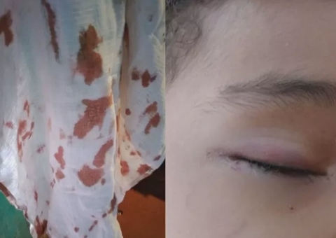 Criança de 3 anos  é atacada por rato enquanto dormia