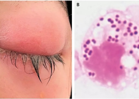 Infecção sexualmente transmissível causa conjuntivite que pode levar a cegueira