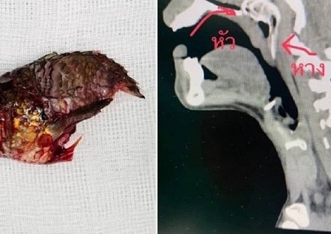 Peixe pula na boca de pescador e fica entalado na garganta do homem