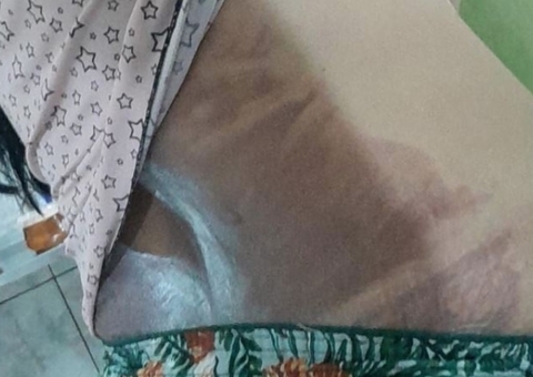 Suspeito de jogar água quente na esposa em Manaus é preso e diz que foi um 'acidente'