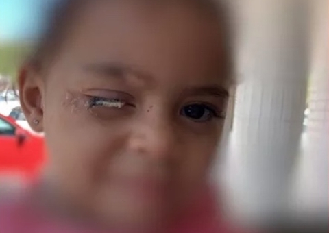 Criança de 2 anos passa cola no olho e família não consegue atendimento para remoção