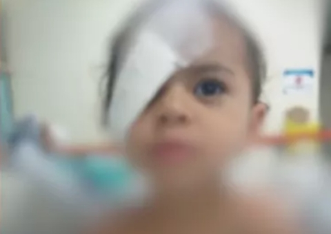 Menina de 2 anos que grudou olho com cola passa por cirurgia