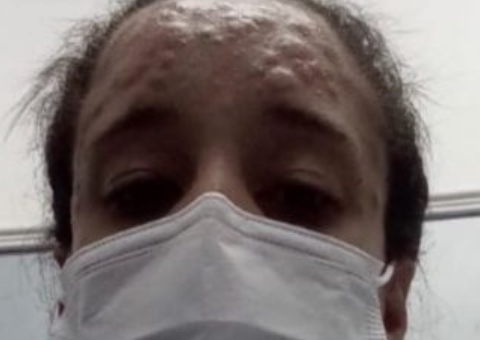 Em vídeo, mulher com suspeita de varíola dos macacos mostra bolhas e relata sintomas