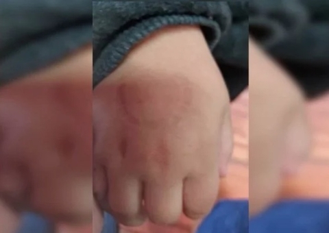 Diretora morde criança de 4 anos e manda mensagem aos pais: "não mordi forte"