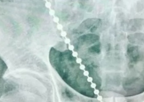 Homem passa por cirurgia após introduzir corrente de bolinhas no pênis 