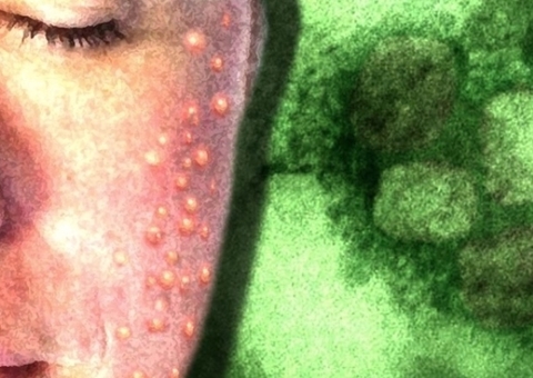 Casos de varíola dos macacos sobem para 21 no Brasil