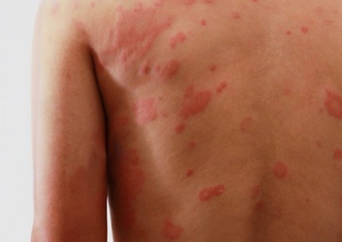 Com 51 de casos novos de hanseníase em Manaus, Semsa orienta sobre autoexame