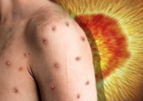 Com 1 caso no Amazonas, Varíola dos Macacos tem maior transmissibilidade pelo sexo