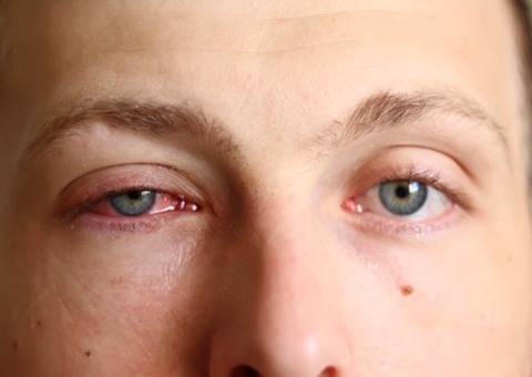 Casos de conjuntivite aumentam no Verão Amazônico; Saiba como prevenir