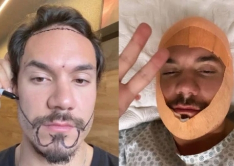 Ex-BBB Eliezer realiza transplante de cabelo e barba para ‘corrigir falhas’