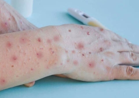 Sobe para 8 número de casos suspeitos de Varíola dos Macacos no Amazonas