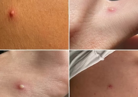 Brasil registra casos de varíola dos macacos em dois bebês