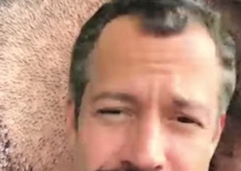 Ex-calvo: Malvino Salvador mostra resultado de transplante capilar