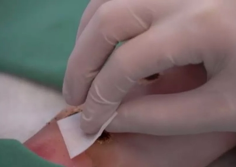 Sobe para 16 o número de casos de varíola dos macacos no Amazonas