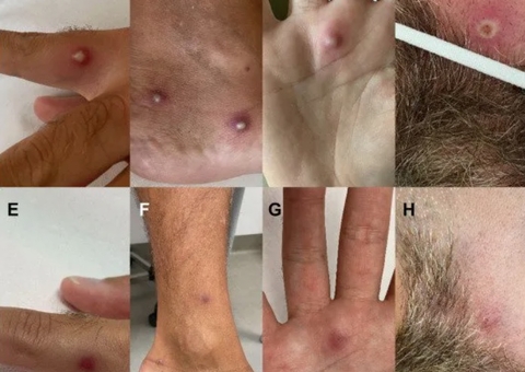 Homem é o 1º do mundo a contrair varíola dos macacos, Covid-19 e HIV ao mesmo tempo