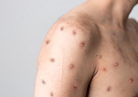 Amazonas confirma 19 casos de varíola dos macacos nesta sexta-feira