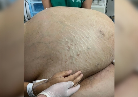 Tumor de 46kg é retirado de mulher em cirurgia de emergência no Brasil
