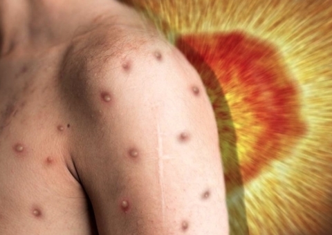 Com 37 confirmados, Amazonas investiga 20 casos suspeitos de varíola dos macacos