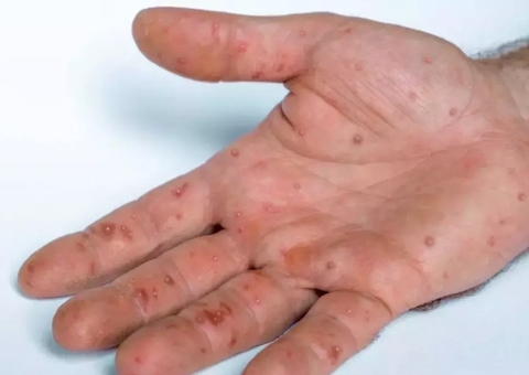 Amazonas tem 32 casos de varíola dos macacos em investigação