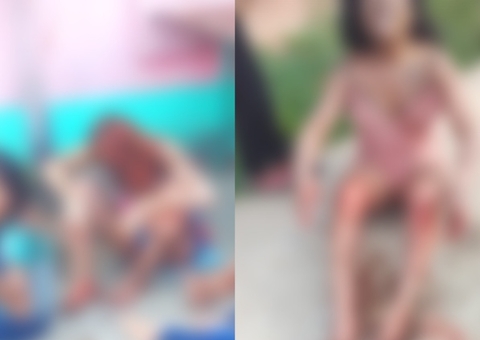 Mulheres e duas crianças sofrem queimaduras graves após casa incendiar no Amazonas