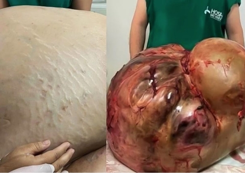 Mulher que teve tumor de 46 kg retirado em cirurgia morre em hospital 