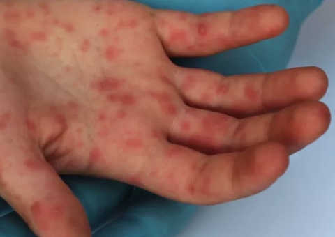 Dia S: estados e municípios farão busca ativa de casos de sarampo e rubéola