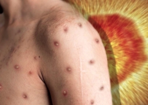 Caso suspeito de varíola dos macacos é investigado em homem de São Gabriel da Cachoeira