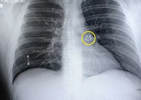 Após tosse severa, homem descobre piercing dentro do pulmão