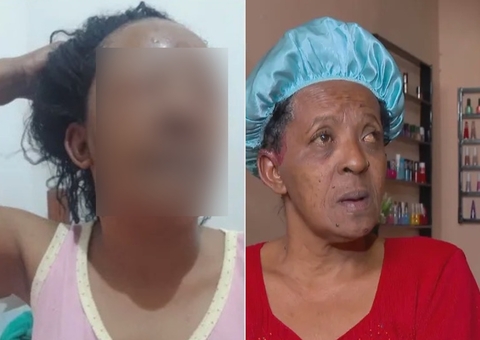 Irreconhecível, mulher fica sem abrir os olhos após ter alergia a relaxamento capilar