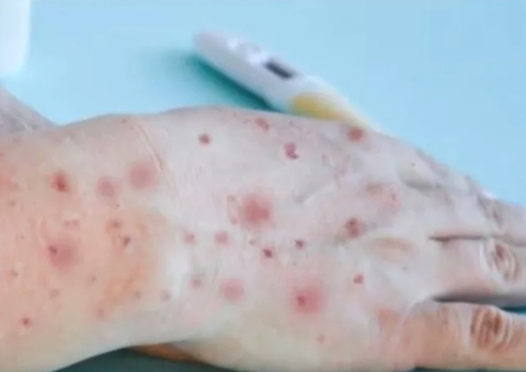 Casos de Varíola dos Macacos sobem para 122 no Amazonas