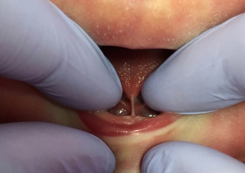 SES-AM assina acordo para realização de cirurgias de correção de freio lingual em bebês 