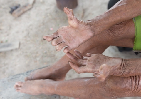 Com 222 novos casos de hanseníase, governo intensifica ações no Amazonas