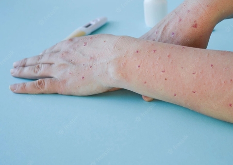 Amazonas chega a 161 casos confirmados de Varíola dos Macacos