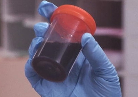 Amazonas registra 20 novos casos da doença da urina preta