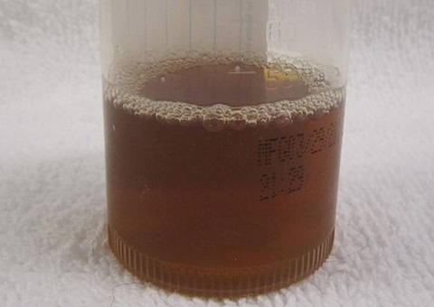 Amazonas chega a 100 casos da doença da urina preta e sete estão internados