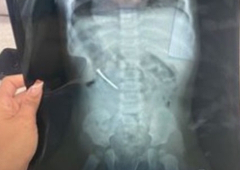 Menina de um ano é internada após engolir prego no dia do aniversário no Pará