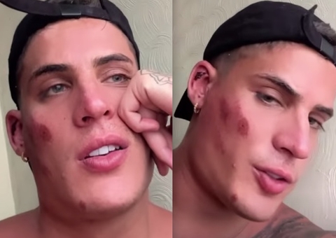 Com rosto machucado, ex-A Fazenda Tiago Ramos explica briga em praia  