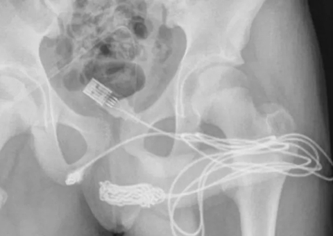 Adolescente enfia cabo USB dentro do pênis e vai parar no hospital