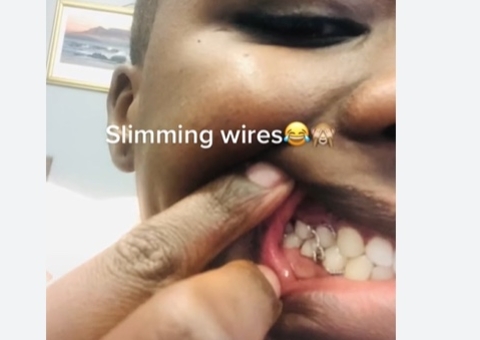 Para emagrecer, mulher usa aparelho para 'trancar' os dentes por 7 semanas