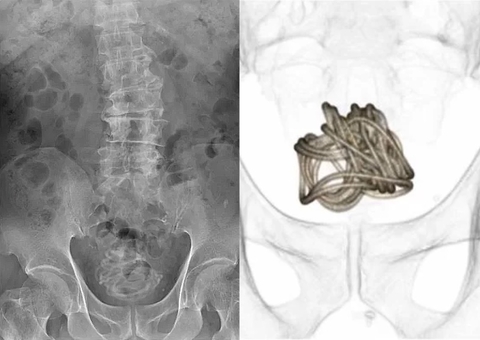 Homem enfia corda de 2,3 metros no pênis e objeto vai parar na bexiga