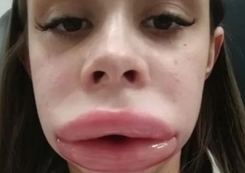 Jovem fica com rosto inchado após preenchimento labial e descobre doença rara