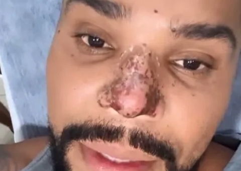 Entenda os motivos que podem ter causado necrose no nariz do cantor Naldo Benny
